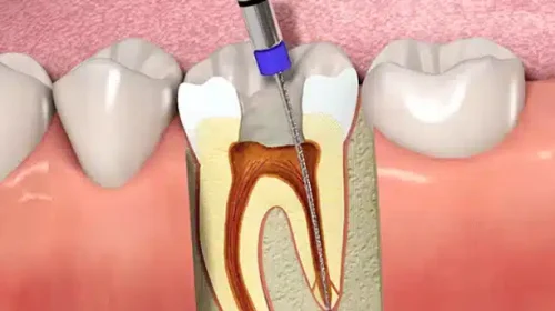 The image shows a dentist using a drill to remove the root of a tooth.