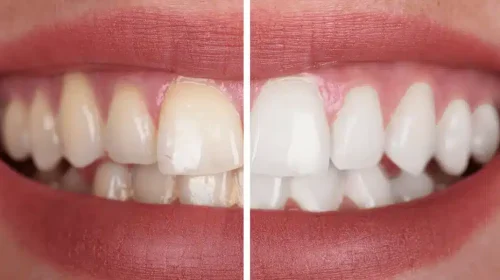 Before-and-after photo of teeth whitening. The left photo shows yellowed teeth, and the right photo shows white teeth.